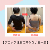 【五十肩ってどうしてなるの？どうやって治す？】